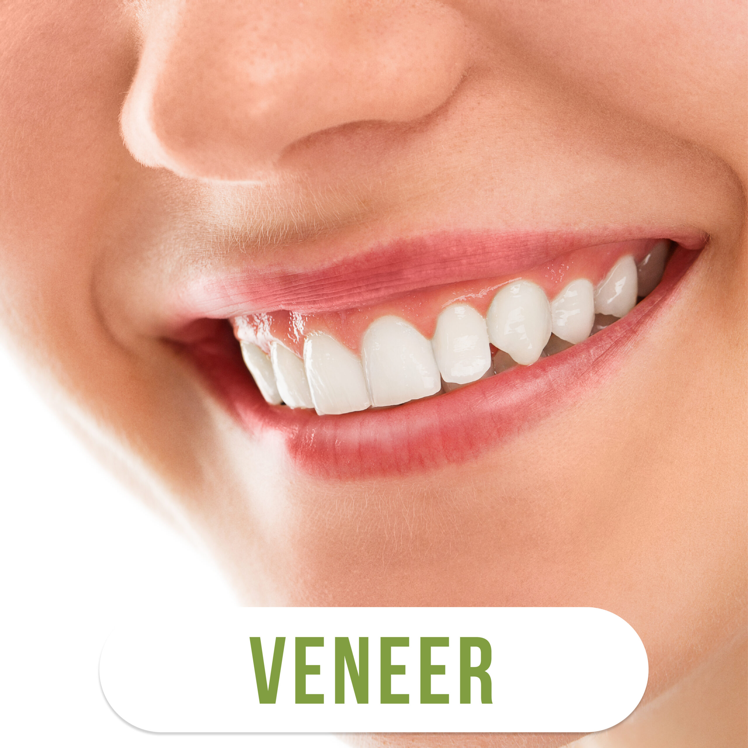 Veneer เริ่มที่